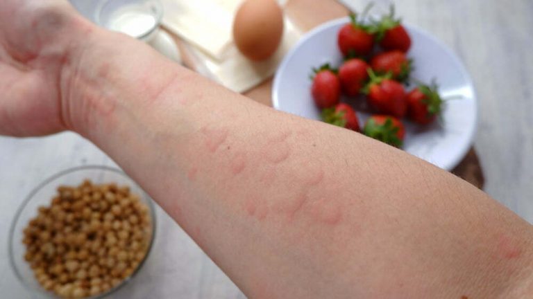 Alergia ao amendoim e aos frutos secos de casca dura | ICA - Instituto ...